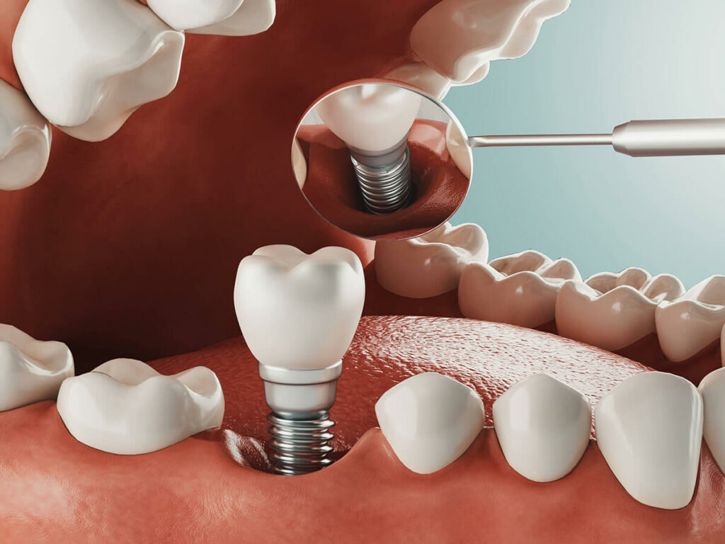 dental implant diagram