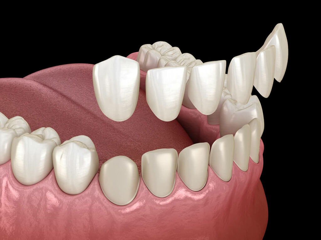 dental veneers replacing old teeth diagram