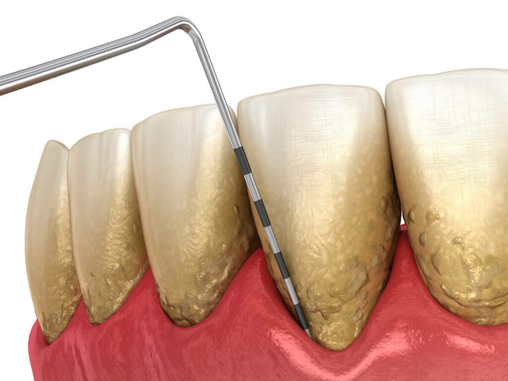 periodontal disease treatment treating diseased teeth