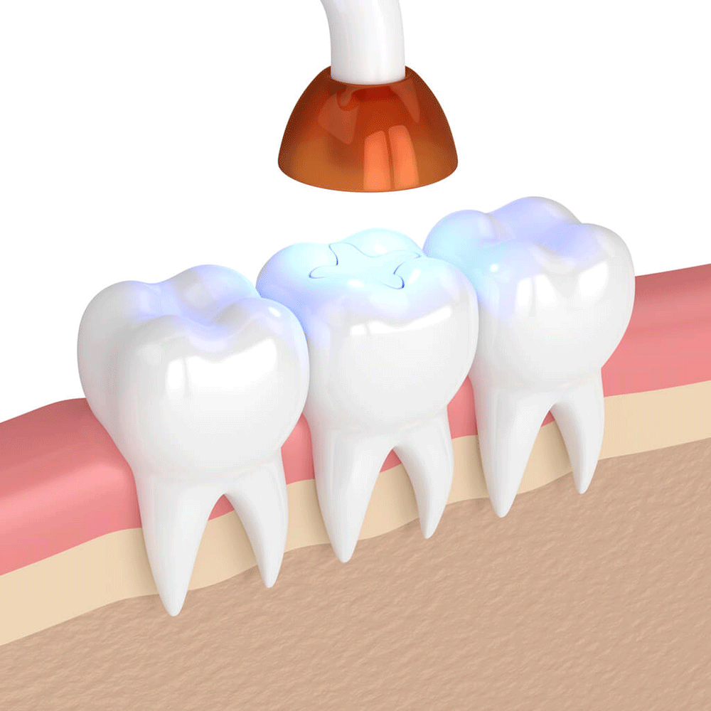 tooth filling diagram