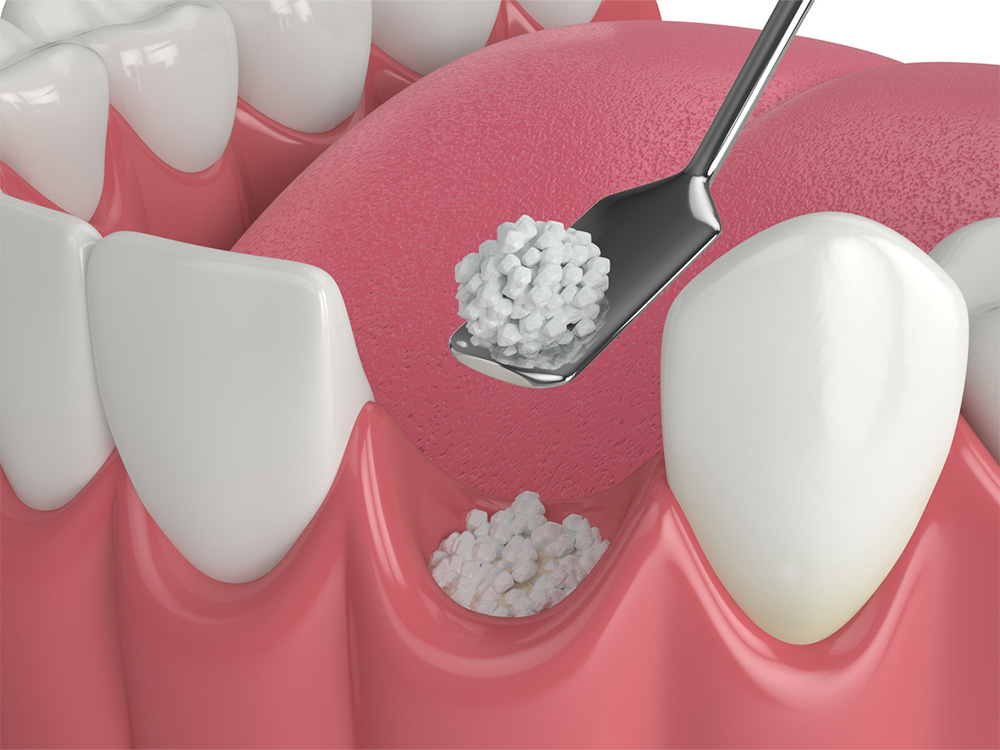 dental bone grafting diagram