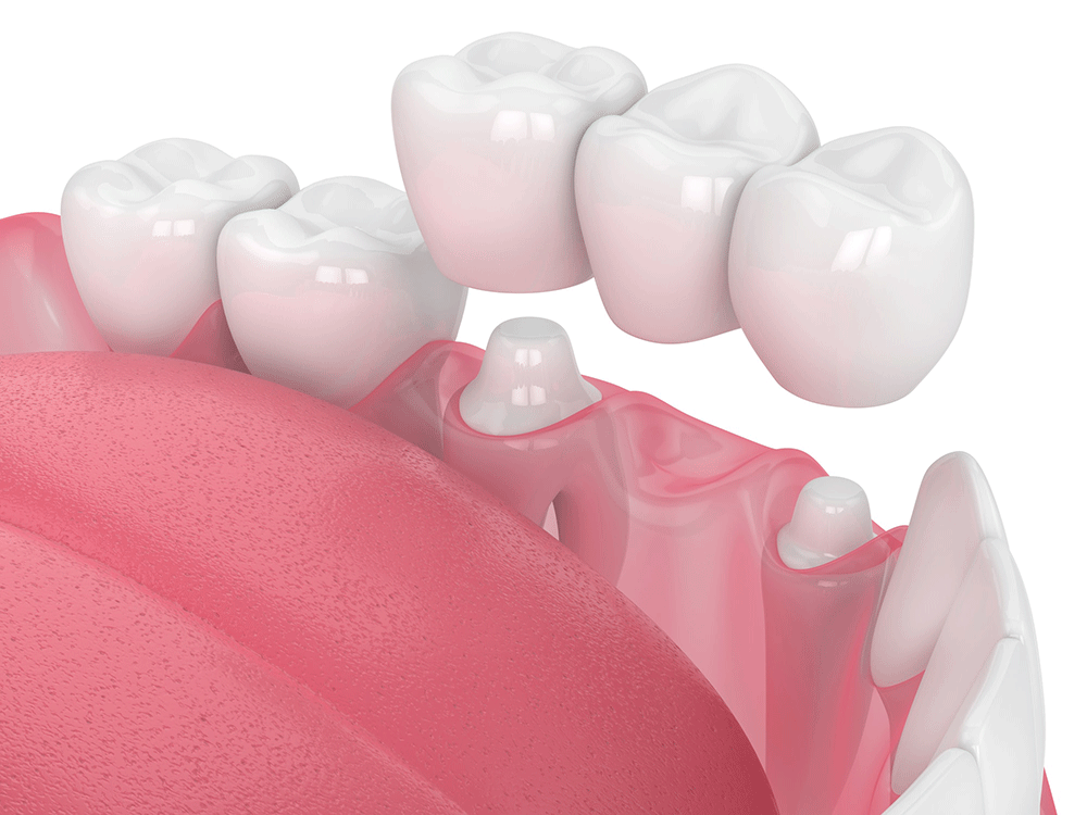 dental crowns and dental bridges diagram